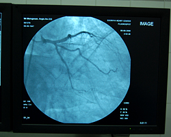 Left Coronary Angiogram