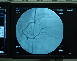 Right Coronary Angiogram