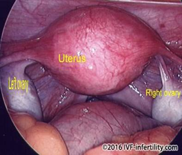 Best Hospital for Endometriosis in chennai