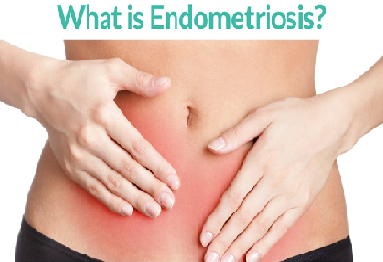 Best Hospital for Endometriosis in chennai